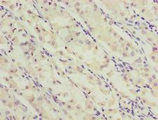 SLC52A2 / GPR172A / PAR1 Antibody - Immunohistochemistry of paraffin-embedded human gastric cancer using SLC52A2 Antibody at dilution of 1:100