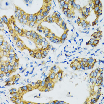 SLC5A1 / SGLT1 Antibody - Immunohistochemistry of paraffin-embedded human gastric cancer tissue.