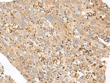 SLC5A1 / SGLT1 Antibody - Immunohistochemistry of paraffin-embedded Human cervical cancer tissue  using SLC5A1 Polyclonal Antibody at dilution of 1:80(×200)