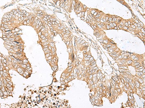 SLC5A1 / SGLT1 Antibody - Immunohistochemistry of paraffin-embedded Human colorectal cancer tissue  using SLC5A1 Polyclonal Antibody at dilution of 1:80(×200)