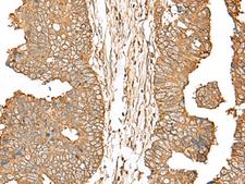SLC5A1 / SGLT1 Antibody - Immunohistochemistry of paraffin-embedded Human colorectal cancer tissue  using SLC5A1 Polyclonal Antibody at dilution of 1:40(×200)