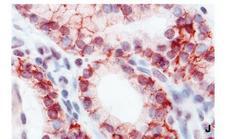 SLC5A5 / NIS Antibody - Paraffin-embedded Graves disease-thyroid gland (Castro et al. 1999 J Clin Endocrinology & Metabolism 84: 2957)