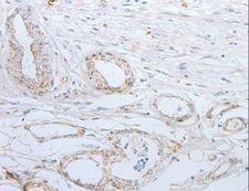 SLC5A5 / NIS Antibody - Immunohistochemistry of paraffin-embedded Human esophagus cancer using SLC5A5 Polyclonal Antibody at dilution of 1:25.