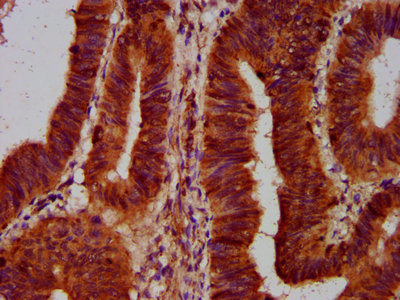 SLC5A5 / NIS Antibody - Immunohistochemistry Dilution at 1:500 and staining in paraffin-embedded human colon cancer performed on a Leica BondTM system. After dewaxing and hydration, antigen retrieval was mediated by high pressure in a citrate buffer (pH 6.0). Section was blocked with 10% normal Goat serum 30min at RT. Then primary antibody (1% BSA) was incubated at 4°C overnight. The primary is detected by a biotinylated Secondary antibody and visualized using an HRP conjugated SP system.