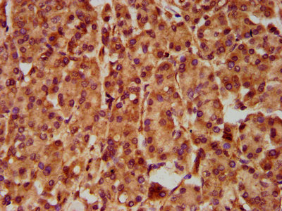 SLC5A5 / NIS Antibody - Immunohistochemistry Dilution at 1:500 and staining in paraffin-embedded human pancreatic cancer performed on a Leica BondTM system. After dewaxing and hydration, antigen retrieval was mediated by high pressure in a citrate buffer (pH 6.0). Section was blocked with 10% normal Goat serum 30min at RT. Then primary antibody (1% BSA) was incubated at 4°C overnight. The primary is detected by a biotinylated Secondary antibody and visualized using an HRP conjugated SP system.
