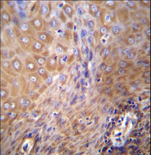 SLC6A14 Antibody - SLC6A14 Antibody immunohistochemistry of formalin-fixed and paraffin-embedded human esophageal carcinoma followed by peroxidase-conjugated secondary antibody and DAB staining.