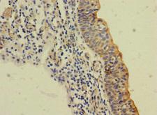 SLC6A15 / SBAT1 Antibody - Immunohistochemistry of paraffin-embedded human bladder cancer using SLC6A15 Antibody at dilution of 1:100