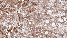 SLC6A20 Antibody - 1:100 staining human liver carcinoma tissues by IHC-P. The sample was formaldehyde fixed and a heat mediated antigen retrieval step in citrate buffer was performed. The sample was then blocked and incubated with the antibody for 1.5 hours at 22°C. An HRP conjugated goat anti-rabbit antibody was used as the secondary.