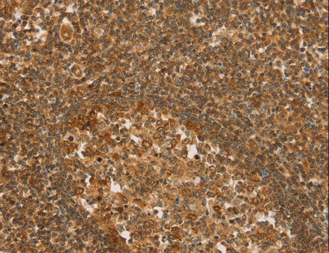 SLC6A3 / Dopamine Transporter Antibody - Immunohistochemistry of paraffin-embedded Human gastric cancer using SLC6A3 Polyclonal Antibody at dilution of 1:50.