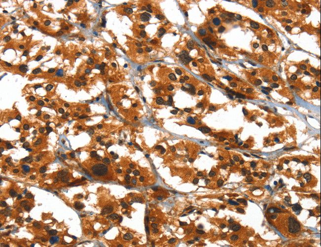 SLC6A4 / SERT Antibody - Immunohistochemistry of paraffin-embedded Human thyroid cancer using SLC6A4 Polyclonal Antibody at dilution of 1:50.
