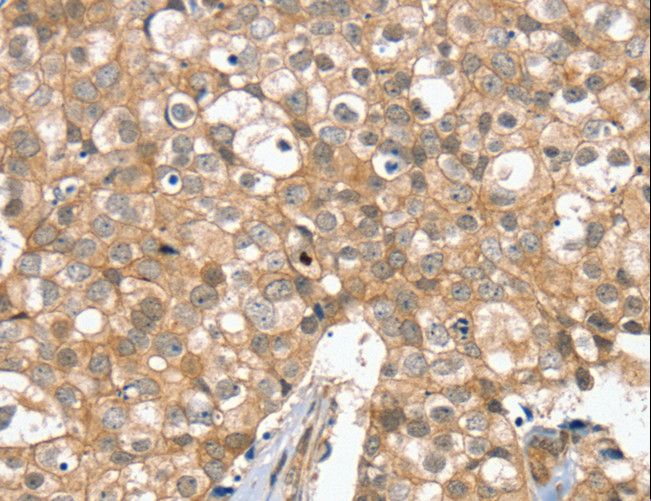 SLC6A7 Antibody - Immunohistochemistry of paraffin-embedded Human breast cancer using SLC6A7 Polyclonal Antibody at dilution of 1:30.