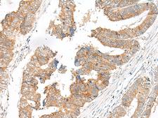 SLC6A9 / GLYT1 Antibody - Immunohistochemistry of paraffin-embedded Human colorectal cancer tissue  using SLC6A9 Polyclonal Antibody at dilution of 1:25(×200)