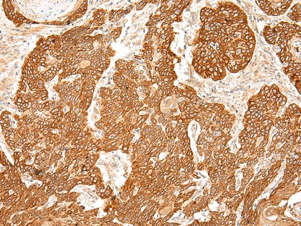 SLC6A9 / GLYT1 Antibody - Immunohistochemistry of paraffin-embedded Human esophagus cancer tissue  using SLC6A9 Polyclonal Antibody at dilution of 1:50(×200)
