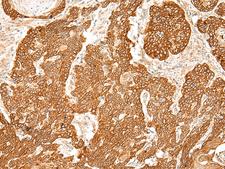 SLC6A9 / GLYT1 Antibody - Immunohistochemistry of paraffin-embedded Human esophagus cancer tissue  using SLC6A9 Polyclonal Antibody at dilution of 1:50(×200)