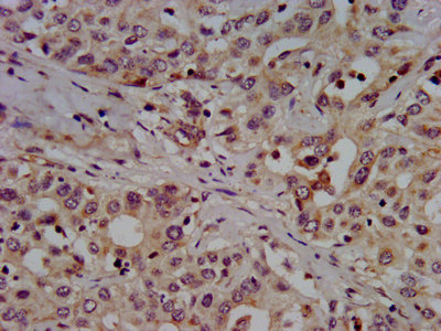SLC7A1 / CAT1 Antibody - Immunohistochemistry image at a dilution of 1:500 and staining in paraffin-embedded human liver cancer performed on a Leica BondTM system. After dewaxing and hydration, antigen retrieval was mediated by high pressure in a citrate buffer (pH 6.0) . Section was blocked with 10% normal goat serum 30min at RT. Then primary antibody (1% BSA) was incubated at 4 °C overnight. The primary is detected by a biotinylated secondary antibody and visualized using an HRP conjugated SP system.