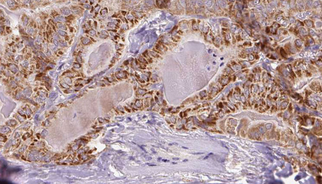 SLC7A11 / XCT Antibody - 1:100 staining human thyroid carcinoma tissue by IHC-P. The sample was formaldehyde fixed and a heat mediated antigen retrieval step in citrate buffer was performed. The sample was then blocked and incubated with the antibody for 1.5 hours at 22°C. An HRP conjugated goat anti-rabbit antibody was used as the secondary.