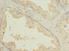 SLC7A14 Antibody - Immunohistochemistry of paraffin-embedded human prostate cancer using antibody at dilution of 1:100.