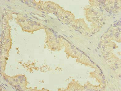 SLC7A14 Antibody - Immunohistochemistry of paraffin-embedded human prostate cancer using SLC7A14 Antibody at dilution of 1:100