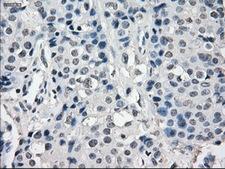 SLC7A8 / LAT2 Antibody - IHC of paraffin-embedded Adenocarcinoma of breast tissue using anti-SLC7A8 mouse monoclonal antibody. (Dilution 1:50).