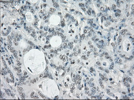 SLC7A8 / LAT2 Antibody - IHC of paraffin-embedded Adenocarcinoma of colon tissue using anti-SLC7A8 mouse monoclonal antibody. (Dilution 1:50).