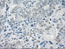 SLC7A8 / LAT2 Antibody - IHC of paraffin-embedded Adenocarcinoma of ovary tissue using anti-SLC7A8 mouse monoclonal antibody. (Dilution 1:50).