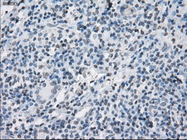 SLC7A8 / LAT2 Antibody - IHC of paraffin-embedded Carcinoma of thyroid tissue using anti-SLC7A8 mouse monoclonal antibody. (Dilution 1:50).