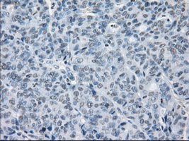 SLC7A8 / LAT2 Antibody - IHC of paraffin-embedded Adenocarcinoma of endometrium tissue using anti-SLC7A8 mouse monoclonal antibody. (Dilution 1:50).
