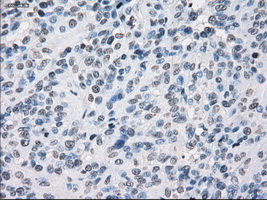 SLC7A8 / LAT2 Antibody - IHC of paraffin-embedded Carcinoma of bladder tissue using anti-SLC7A8 mouse monoclonal antibody. (Dilution 1:50).