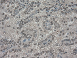SLC7A8 / LAT2 Antibody - IHC of paraffin-embedded Carcinoma of kidney tissue using anti-SLC7A8 mouse monoclonal antibody. (Dilution 1:50).