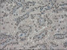 SLC7A8 / LAT2 Antibody - IHC of paraffin-embedded Carcinoma of kidney tissue using anti-SLC7A8 mouse monoclonal antibody. (Dilution 1:50).