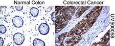 SLC7A8 / LAT2 Antibody - Immunohistochemical staining of paraffin-embedded Human normal colon tissue and colorectal cancer tissue using anti-SLC7A8 mouse monoclonal antibody.  heat-induced epitope retrieval by 10mM citric buffer, pH6.0, 120C for 3min)
