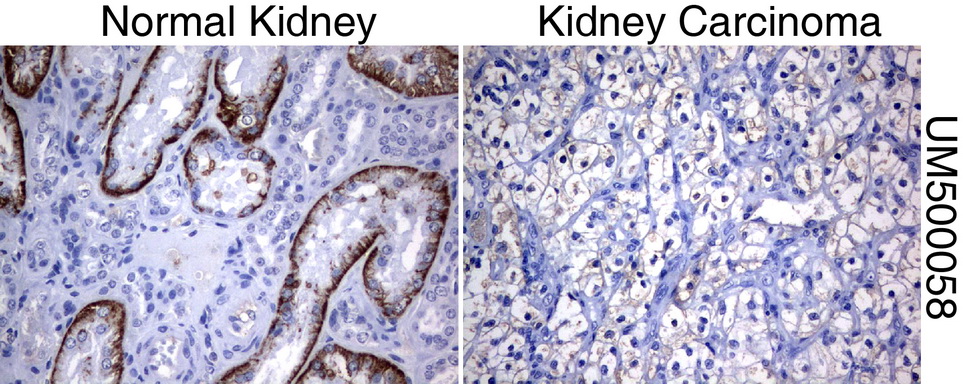 SLC7A8 / LAT2 Antibody - Immunohistochemical staining of paraffin-embedded Human normal kidney tissue and kidney carcinoma tissue using anti-SLC7A8 mouse monoclonal antibody.  heat-induced epitope retrieval by 10mM citric buffer, pH6.0, 120C for 3min)