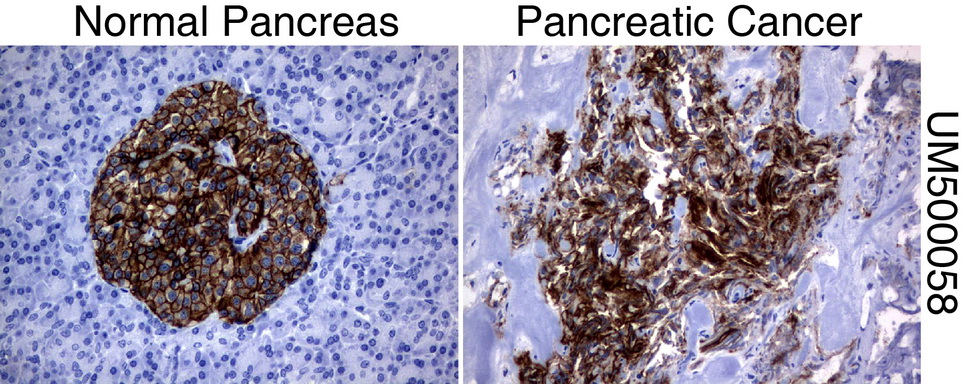 SLC7A8 / LAT2 Antibody - Immunohistochemical staining of paraffin-embedded Human normal pancreas tissue and pancreatic cancer tissue using anti-SLC7A8 mouse monoclonal antibody.  heat-induced epitope retrieval by 10mM citric buffer, pH6.0, 120C for 3min)