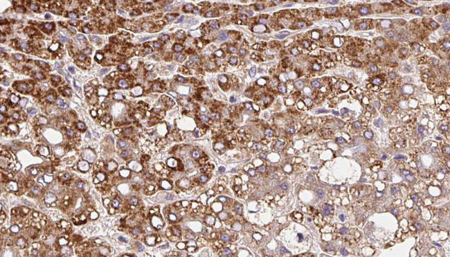 SLC8A1 / NCX1 Antibody - 1:100 staining human liver carcinoma tissues by IHC-P. The sample was formaldehyde fixed and a heat mediated antigen retrieval step in citrate buffer was performed. The sample was then blocked and incubated with the antibody for 1.5 hours at 22°C. An HRP conjugated goat anti-rabbit antibody was used as the secondary.