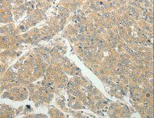 SLC8A3 / NCX3 Antibody - Immunohistochemistry of paraffin-embedded Human liver cancer using SLC8A3 Polyclonal Antibody at dilution of 1:50.