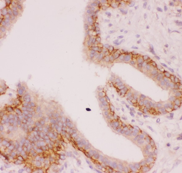 SLC9A1 / NHE1 Antibody - SLC9A1 antibody IHC-paraffin: Human Mammary Cancer Tissue.