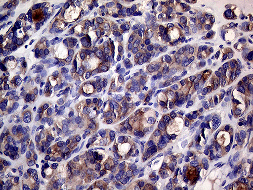 SLC9A1BP / CHP Antibody - Immunohistochemical staining of paraffin-embedded Carcinoma of Human thyroid tissue using anti-CHP1 mouse monoclonal antibody. (Heat-induced epitope retrieval by 1mM EDTA in 10mM Tris buffer. (pH8.5) at 120°C for 3 min. (1:250)