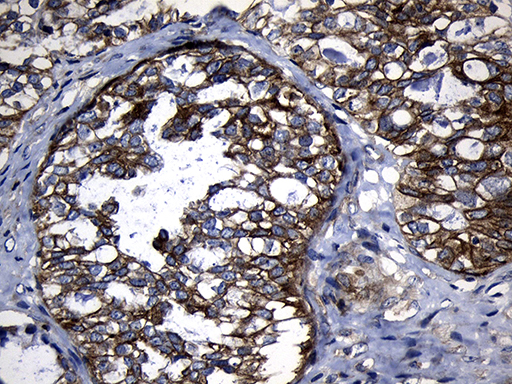 SLC9A1BP / CHP Antibody - Immunohistochemical staining of paraffin-embedded Adenocarcinoma of Human ovary tissue using anti-CHP mouse monoclonal antibody. (Heat-induced epitope retrieval by 1mM EDTA in 10mM Tris buffer. (pH8.5) at 120°C for 3 min. (1:500)