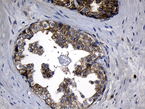 SLC9A1BP / CHP Antibody - Immunohistochemical staining of paraffin-embedded Carcinoma of Human prostate tissue using anti-CHP mouse monoclonal antibody. (Heat-induced epitope retrieval by 1mM EDTA in 10mM Tris buffer. (pH8.5) at 120°C for 3 min. (1:500)