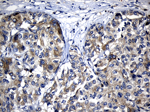 SLC9A1BP / CHP Antibody - Immunohistochemical staining of paraffin-embedded Carcinoma of Human liver tissue using anti-CHP mouse monoclonal antibody. (Heat-induced epitope retrieval by 1mM EDTA in 10mM Tris buffer. (pH8.5) at 120°C for 3 min. (1:500)