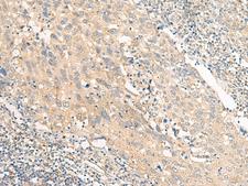 SLC9A1BP / CHP Antibody - Immunohistochemistry of paraffin-embedded Human cervical cancer tissue  using CHP1 Polyclonal Antibody at dilution of 1:25(×200)