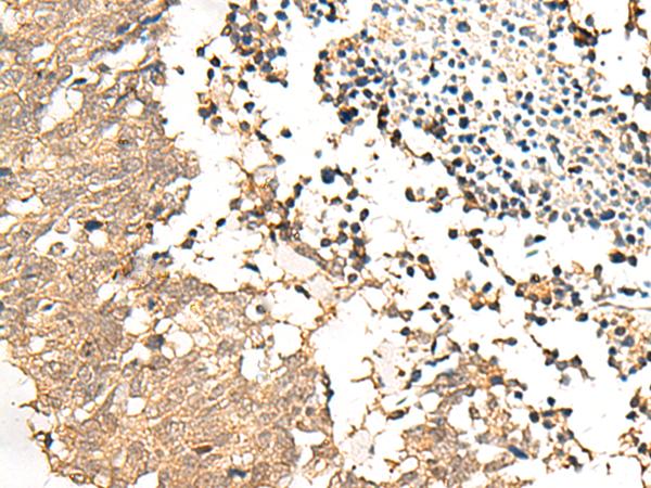 SLC9A1BP / CHP Antibody - Immunohistochemistry of paraffin-embedded Human lung cancer tissue  using CHP1 Polyclonal Antibody at dilution of 1:25(×200)