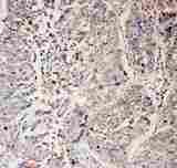 SLC9A2 / NHE2 Antibody - IHC analysis of SLC9A2 using anti-SLC9A2 antibody. SLC9A2 was detected in paraffin-embedded section of human lung cancer tissues. Heat mediated antigen retrieval was performed in citrate buffer (pH6, epitope retrieval solution) for 20 mins. The tissue section was blocked with 10% goat serum. The tissue section was then incubated with 1µg/ml rabbit anti-SLC9A2 Antibody overnight at 4°C. Biotinylated goat anti-rabbit IgG was used as secondary antibody and incubated for 30 minutes at 37°C. The tissue section was developed using Strepavidin-Biotin-Complex (SABC) with DAB as the chromogen.