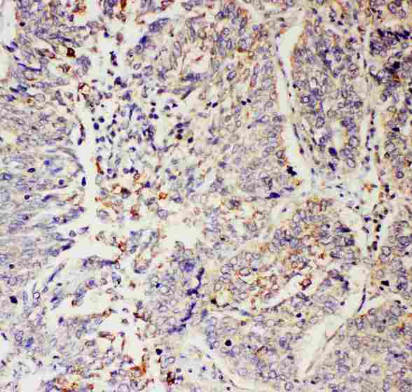 SLC9A2 / NHE2 Antibody - IHC analysis of SLC9A2 using anti-SLC9A2 antibody. SLC9A2 was detected in paraffin-embedded section of human lung cancer tissues. Heat mediated antigen retrieval was performed in citrate buffer (pH6, epitope retrieval solution) for 20 mins. The tissue section was blocked with 10% goat serum. The tissue section was then incubated with 1µg/ml rabbit anti-SLC9A2 Antibody overnight at 4°C. Biotinylated goat anti-rabbit IgG was used as secondary antibody and incubated for 30 minutes at 37°C. The tissue section was developed using Strepavidin-Biotin-Complex (SABC) with DAB as the chromogen.