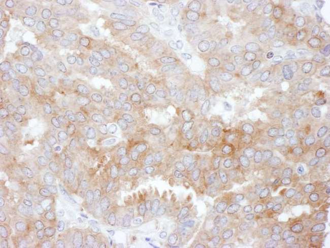SLC9A3R1 / NHERF1 / EBP50 Antibody - Detection of Human NHERF1 by Immunohistochemistry. Sample: FFPE section of human breast carcinoma. Antibody: Affinity purified rabbit anti-NHERF1 used at a dilution of 1:200 (1 ug/ml). Detection: DAB.