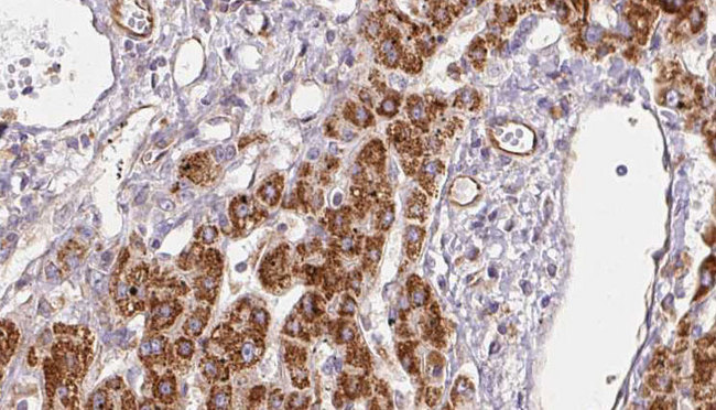 SLC9A3R1 / NHERF1 / EBP50 Antibody - 1:100 staining human liver carcinoma tissues by IHC-P. The sample was formaldehyde fixed and a heat mediated antigen retrieval step in citrate buffer was performed. The sample was then blocked and incubated with the antibody for 1.5 hours at 22°C. An HRP conjugated goat anti-rabbit antibody was used as the secondary.