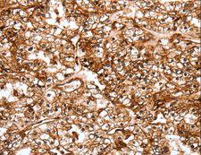 SLC9A3R2 / SIP1 Antibody - Immunohistochemistry of paraffin-embedded Human thyroid cancer using SLC9A3R2 Polyclonal Antibody at dilution of 1:40.