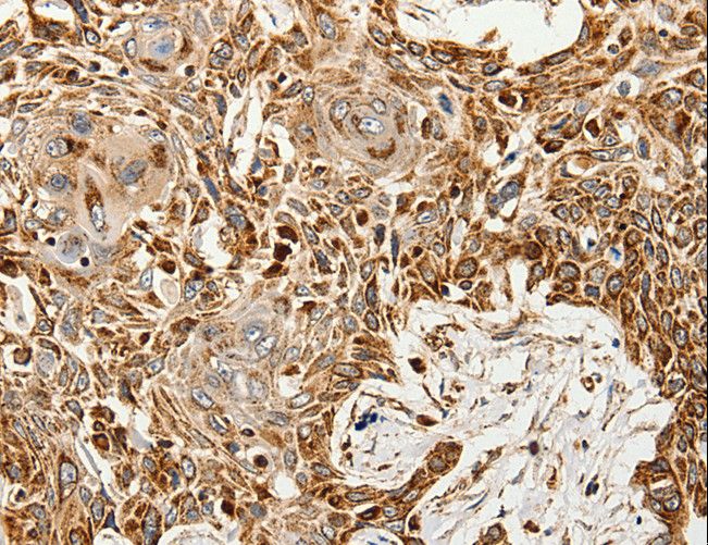 SLC9A7 Antibody - Immunohistochemistry of paraffin-embedded Human esophagus cancer using SLC9A7 Polyclonal Antibody at dilution of 1:60.