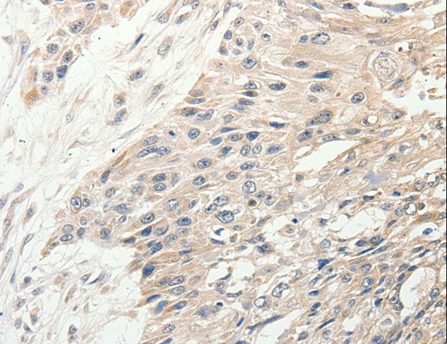 SLC9A7 Antibody - Immunohistochemistry of paraffin-embedded Human esophagus cancer using SLC9A7 Polyclonal Antibody at dilution of 1:50.