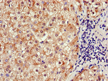 SLCO1B3 / OATP8 Antibody - Immunohistochemistry of paraffin-embedded human liver cancer using SLCO1B3 Antibody at dilution of 1:100